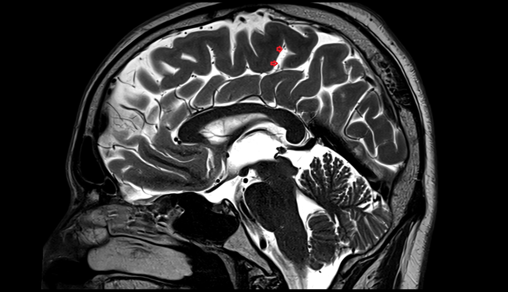 Paracentral sulcus MRI 3T sagittal image