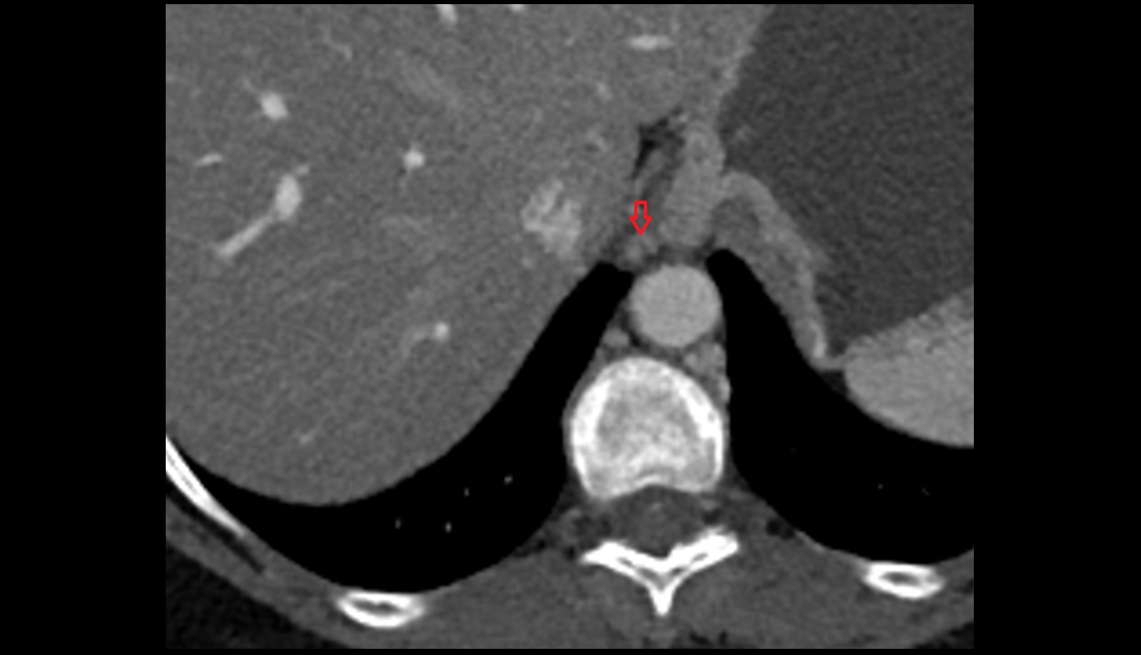 Paraesophageal lymph nodes ct axial image