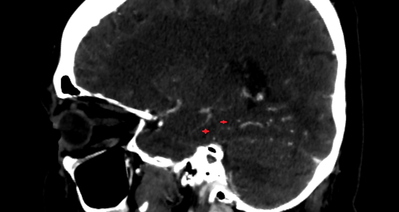 Parahippocampal gyrus  CT sag anatomy image -img-00001-00001