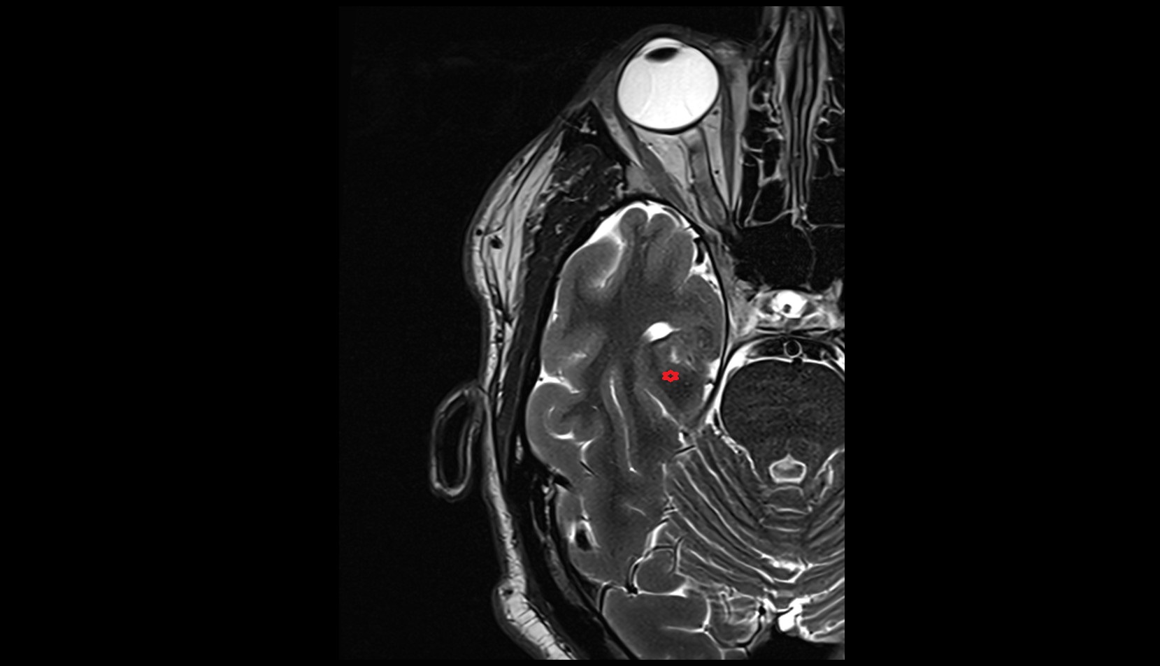 Parahippocampal gyrus MRI 3T axial image