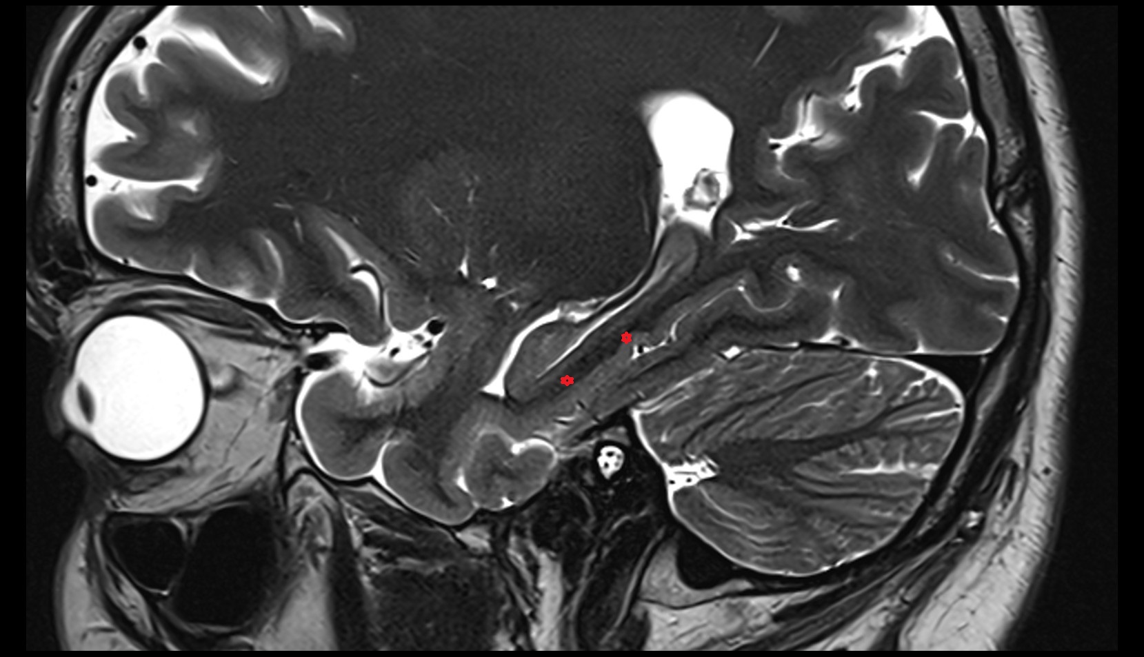 Parahippocampal gyrus MRI 3T sagittal image