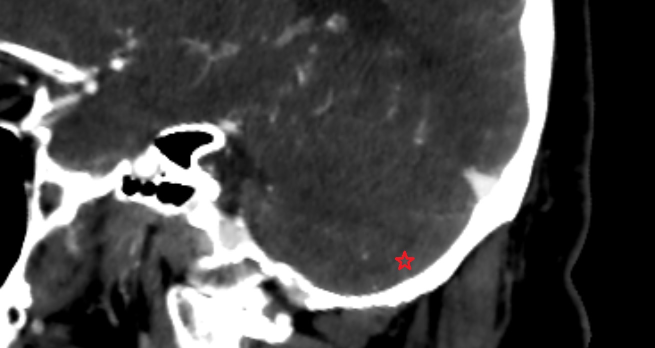 Paramedian lobule  CT sag  anatomy image -img-00001-00001