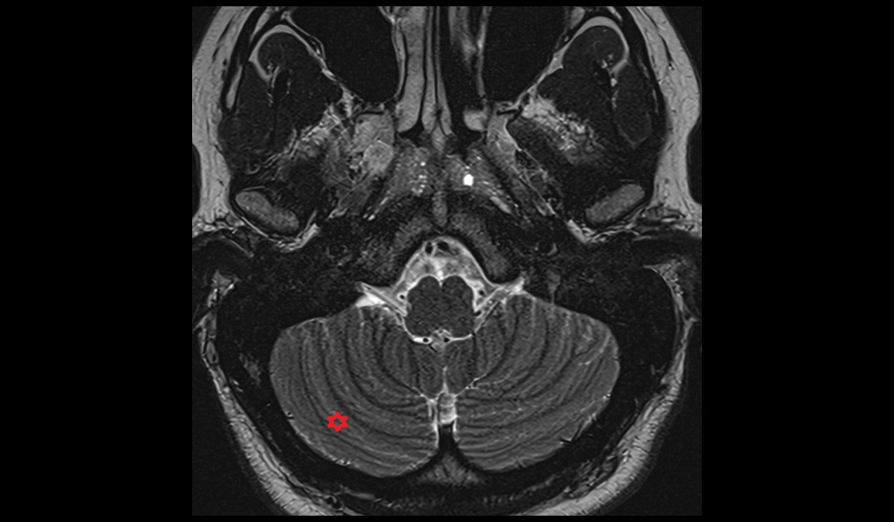 Paramedian lobule MRI 3T axial image