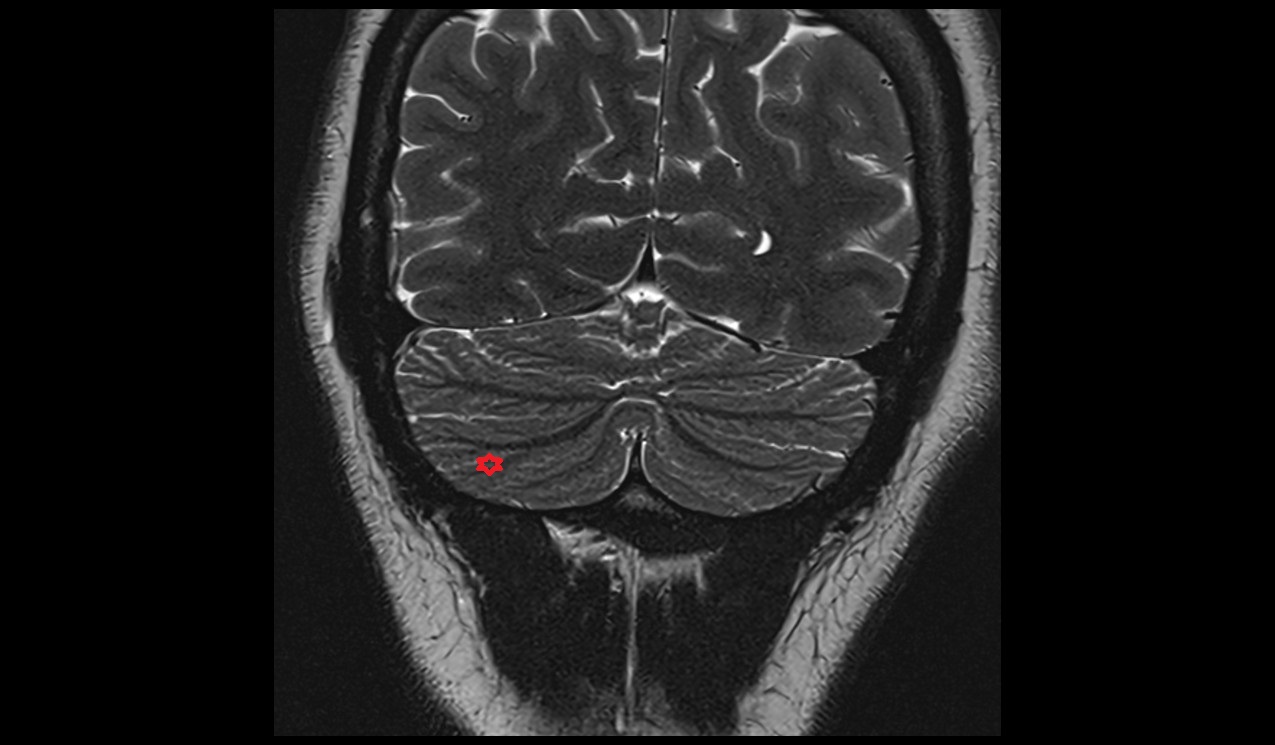Paramedian lobule MRI 3T coronal image