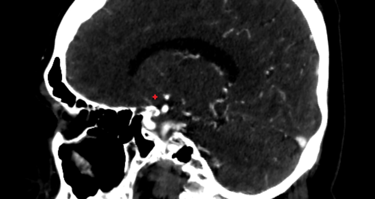 Paraterminal gyrus  CT sag anatomy image -img-00001-00001