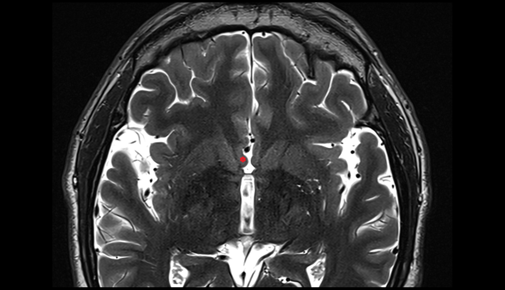 Paraterminal gyrus MRI 3T axial image