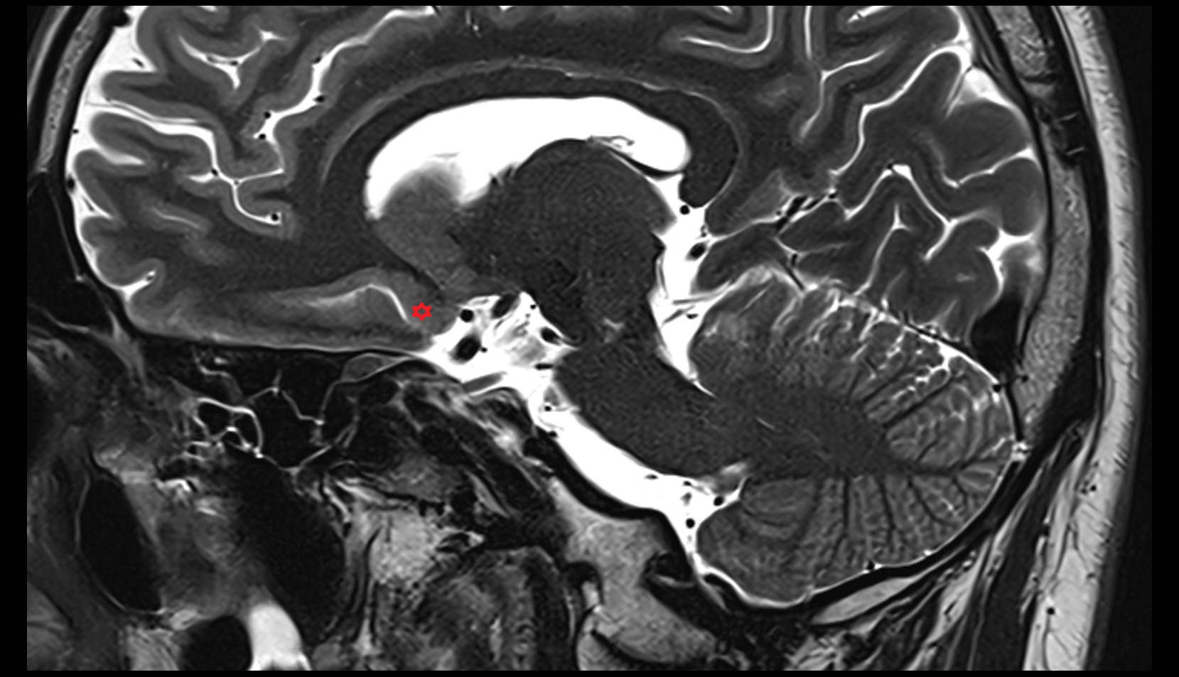 Paraterminal gyrus MRI 3T sagittal image