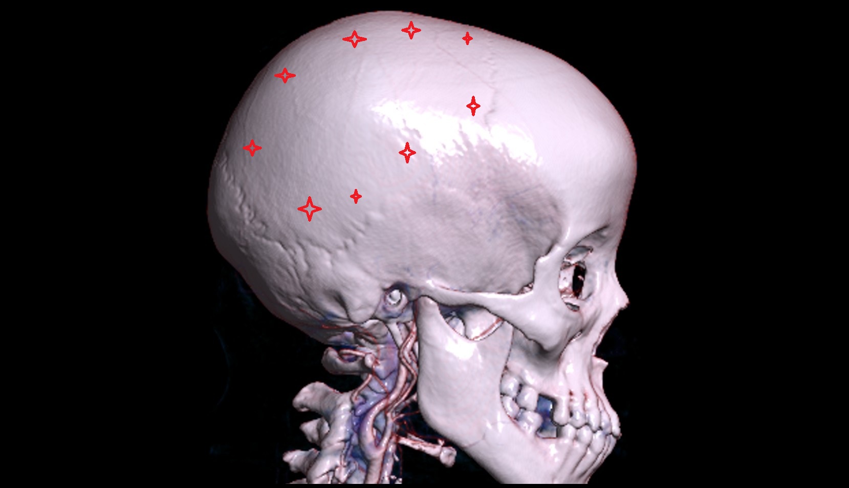 Parietal bone 3d