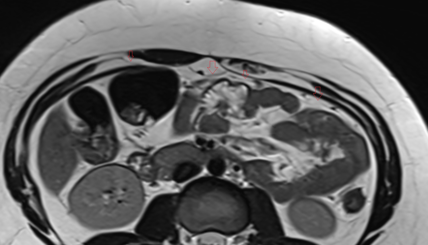 Parietal peritoneum MRI axial  anatomy  image-img-00000-00000
