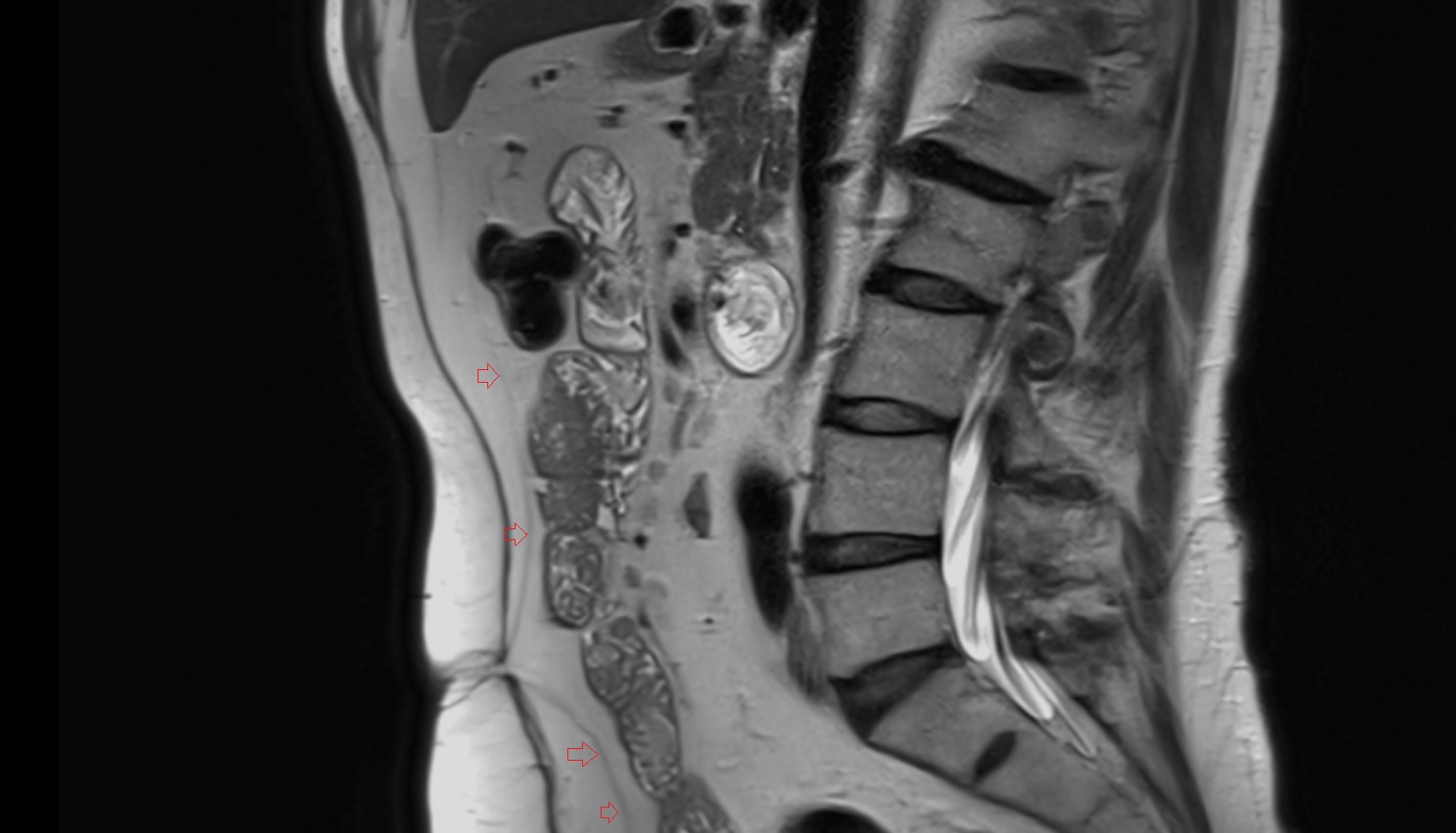 Parietal peritoneum  MRI sag  anatomy  image-img-00000-00000