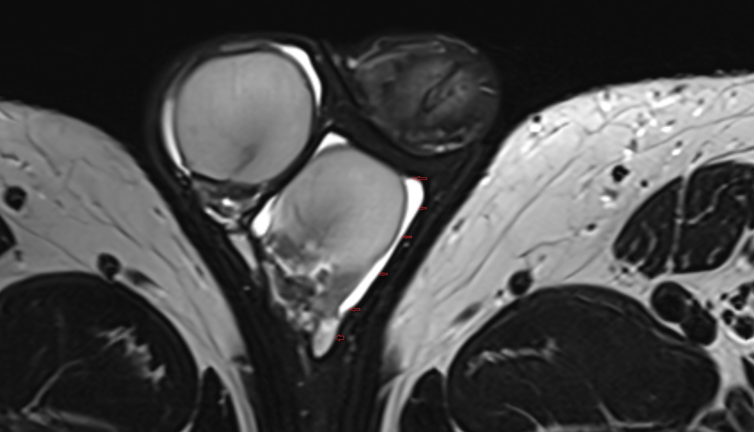 Parietal tunica vaginalis  mri axial  anatomy  image-img-00000-00000