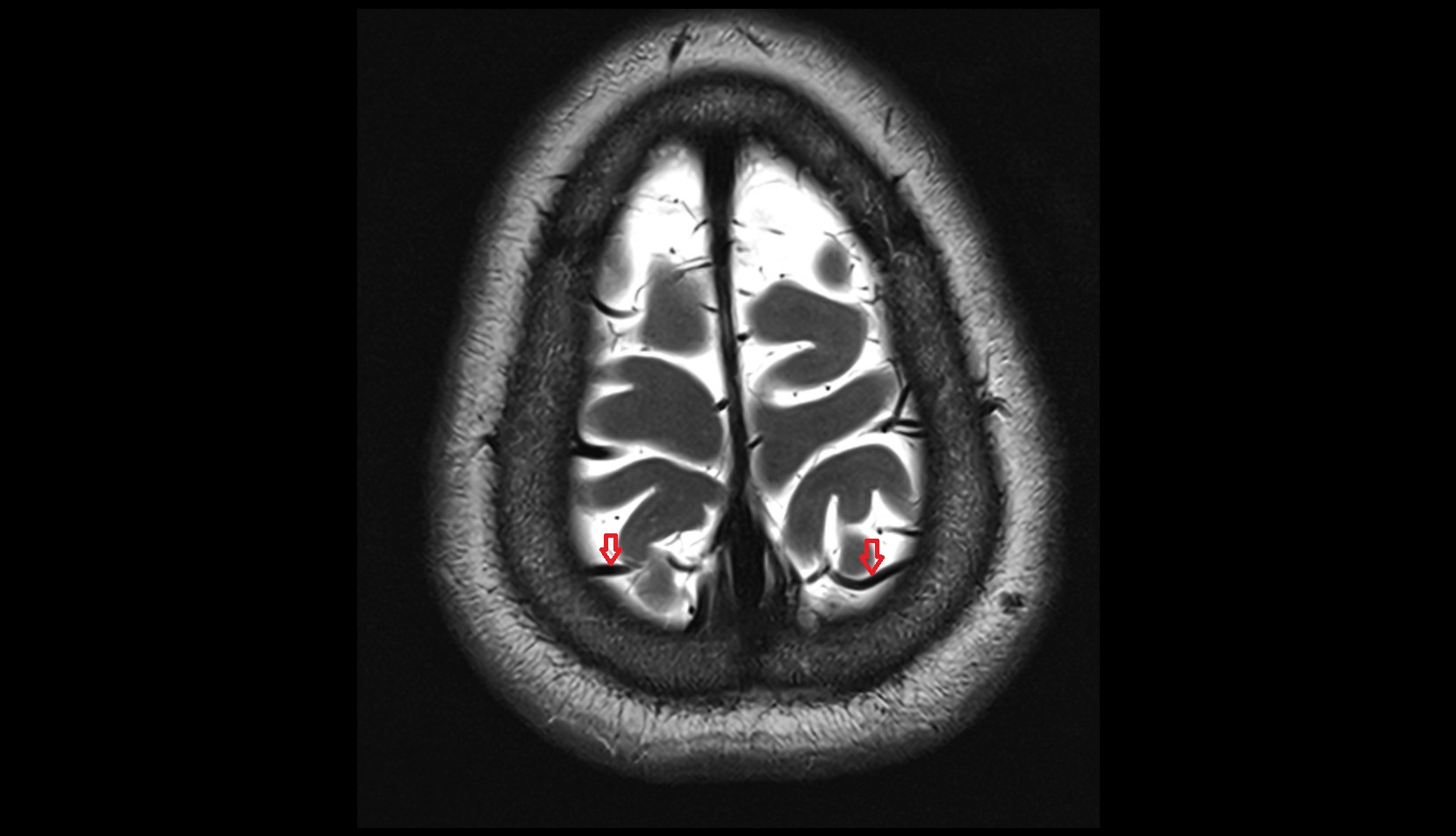 Parietal veins MRI 3T AXIAL IMAGE