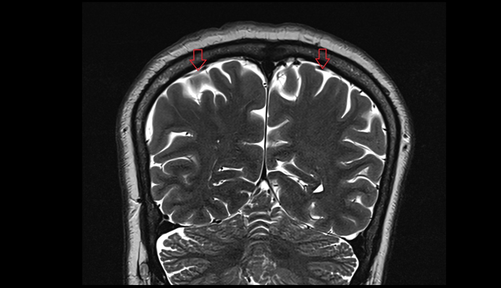Parietal veins MRI 3T coronal image