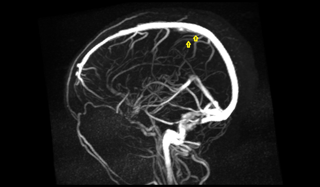 Parietal veins MRI 3T sag mip image