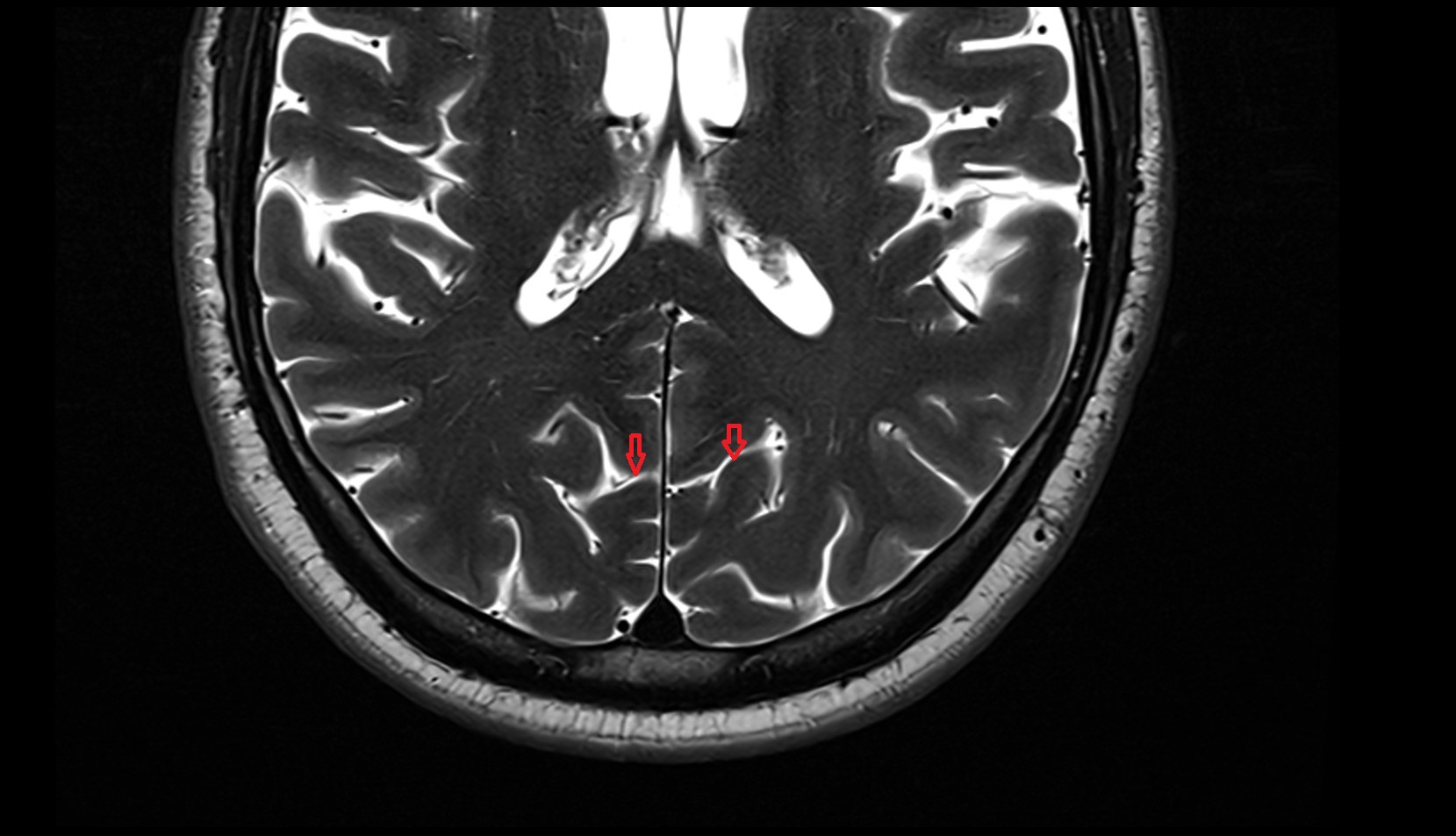 Parietooccipital sulcus MRI 3T axial image