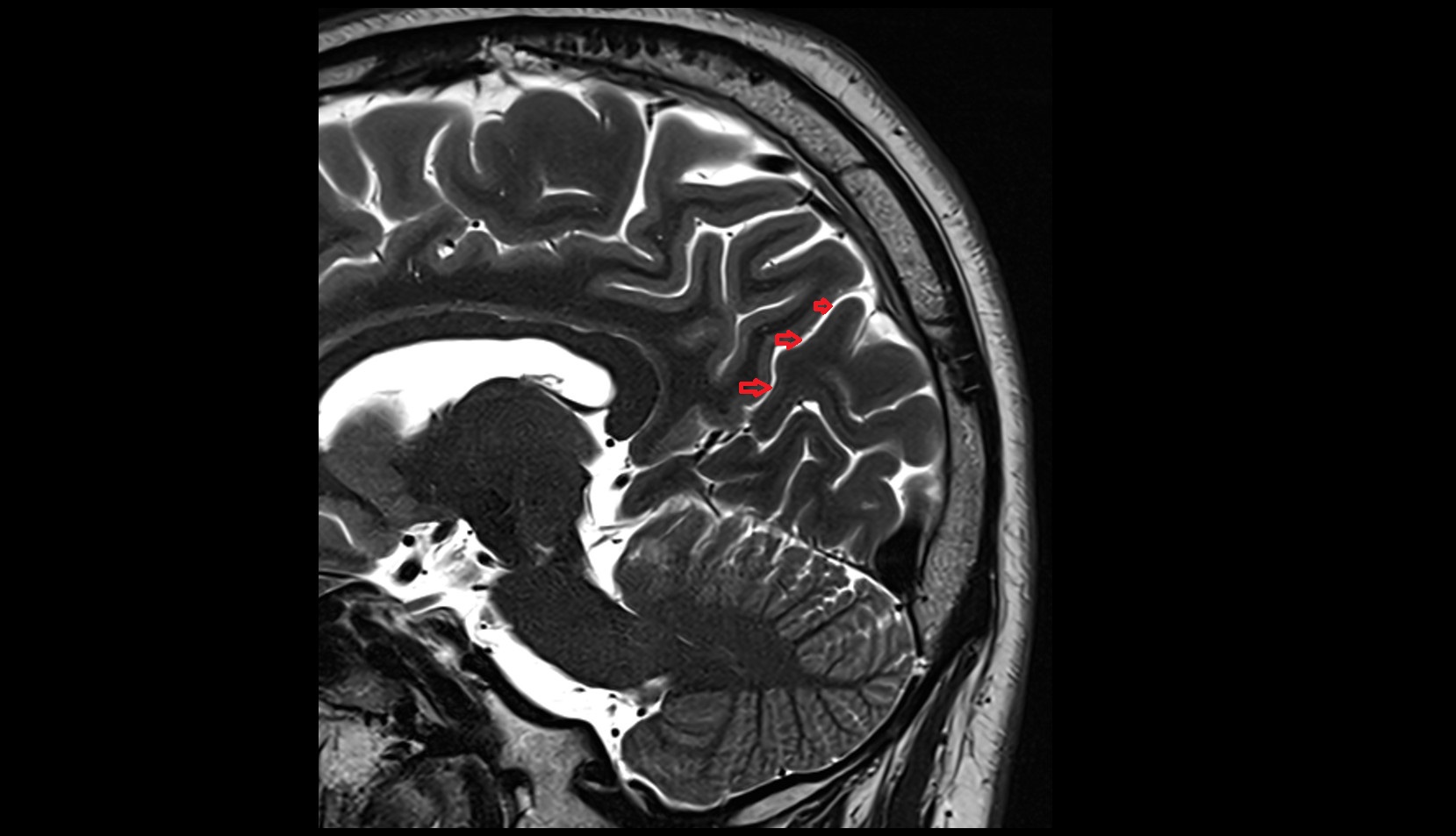 Parietooccipital sulcus MRI 3T sagittal image