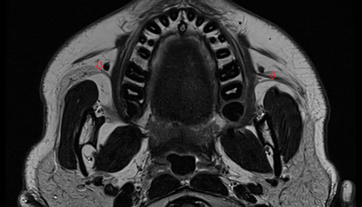 Parotid ductl axial image -img-00000-00000