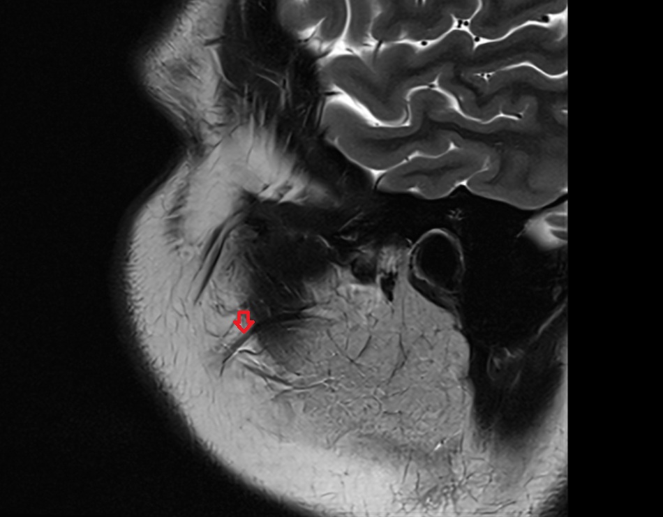 Parotid ductl sag image -img-00000-00000