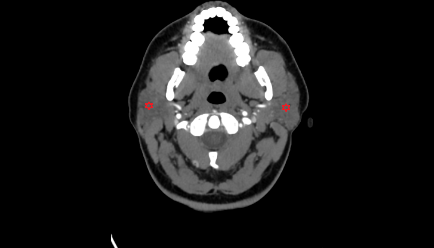 Parotid gland CT axial  image-img-00000-00000