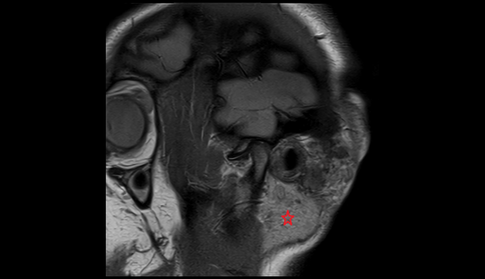 Parotid gland MRI SAG IMAGE