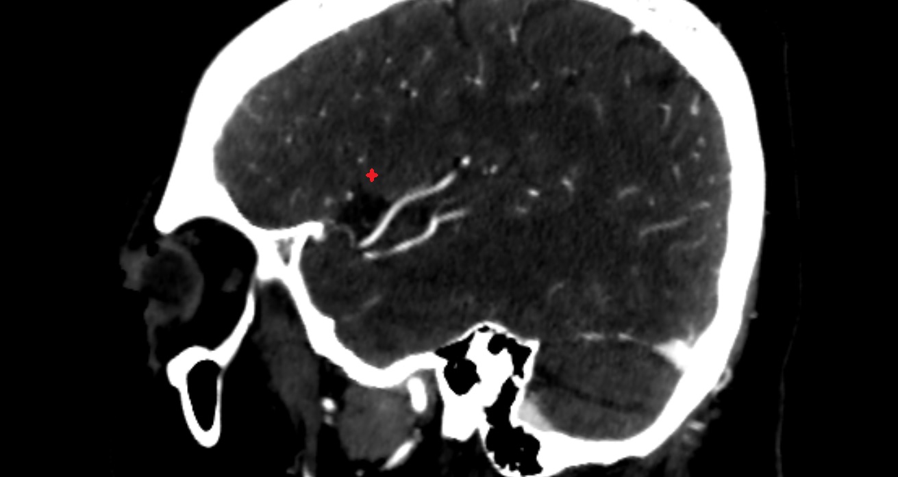 Pars opercularis of inferior frontal gyrus  CT sag anatomy image -img-00001-00001