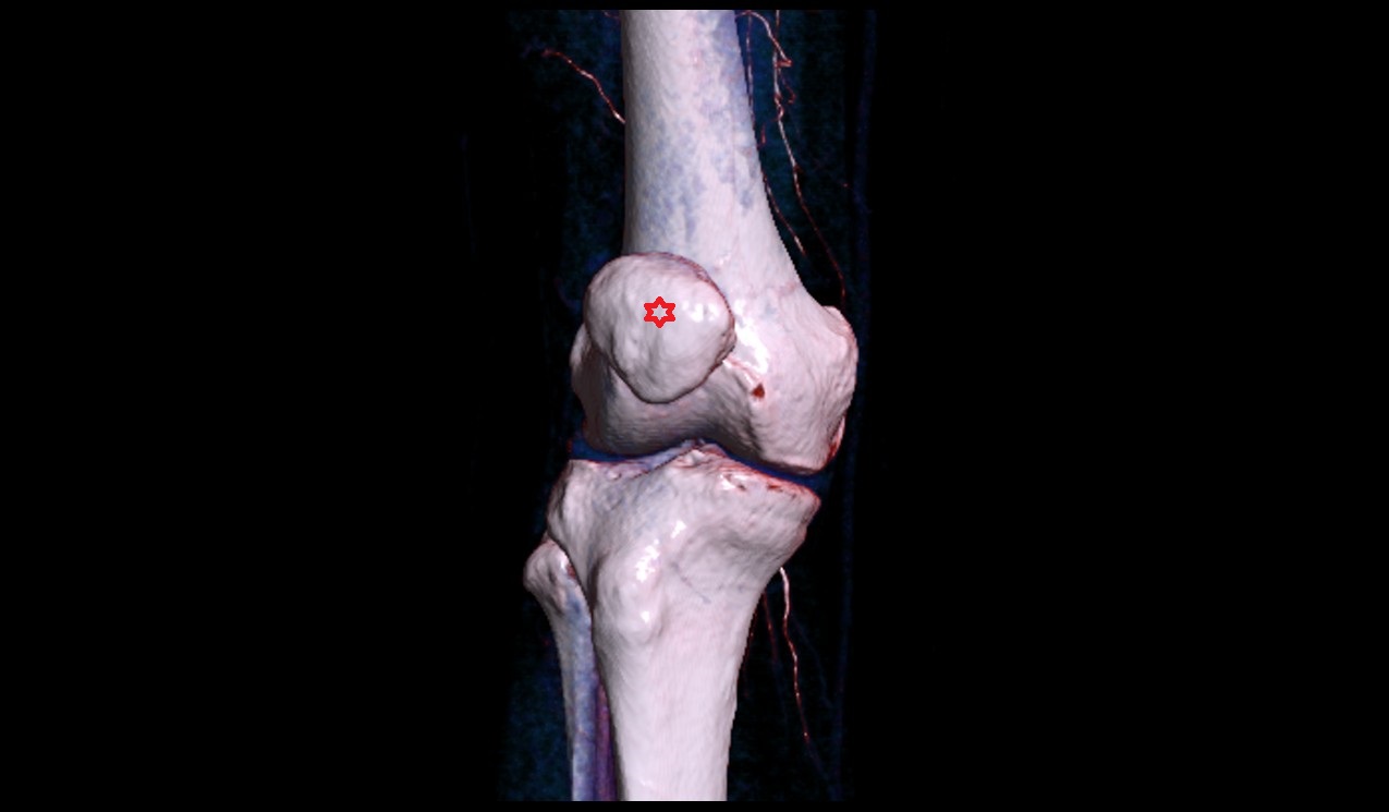 Patella 3d image