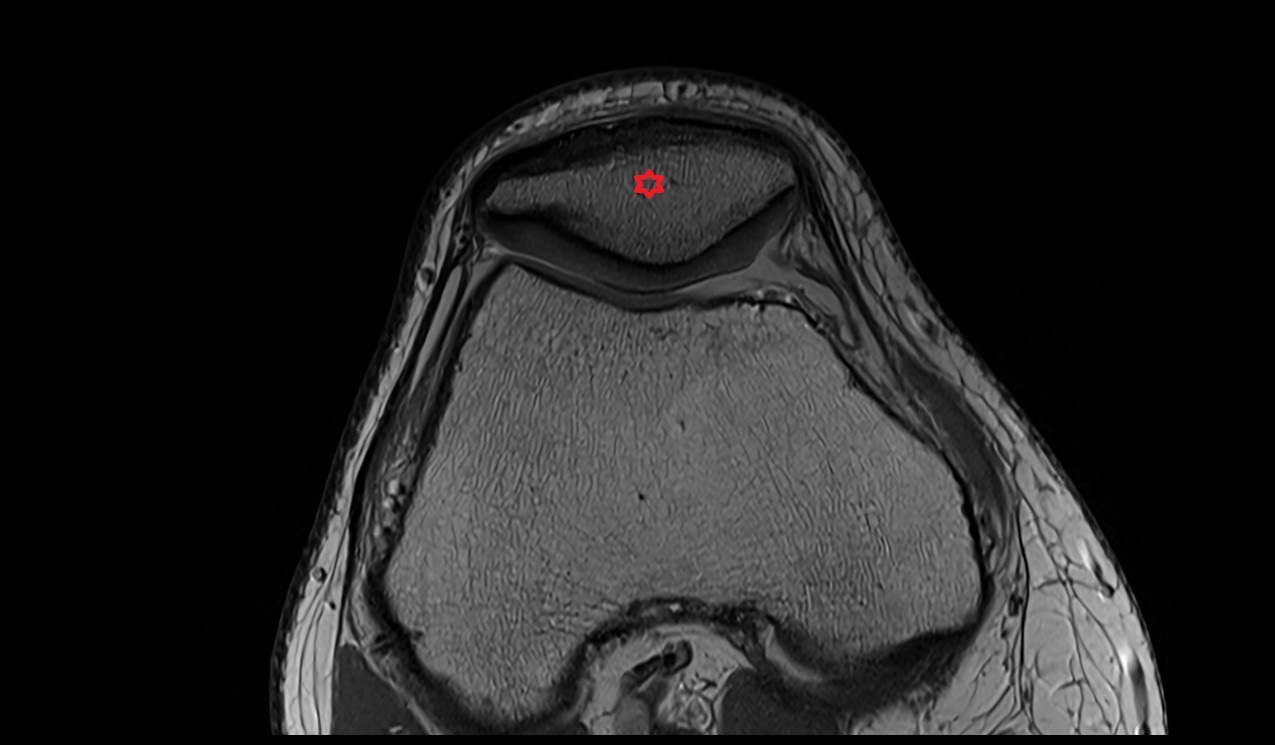 Patella bone anatomy image