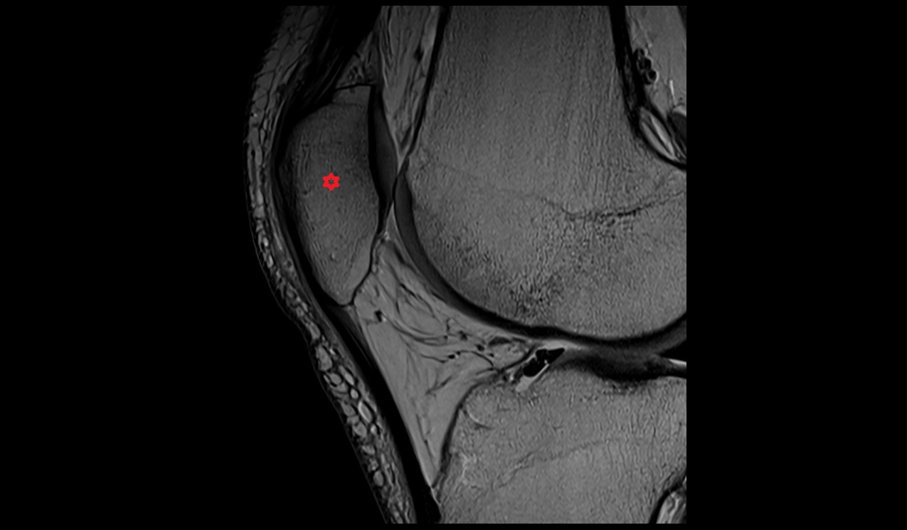 Patella bone anatomy image 3t MRI