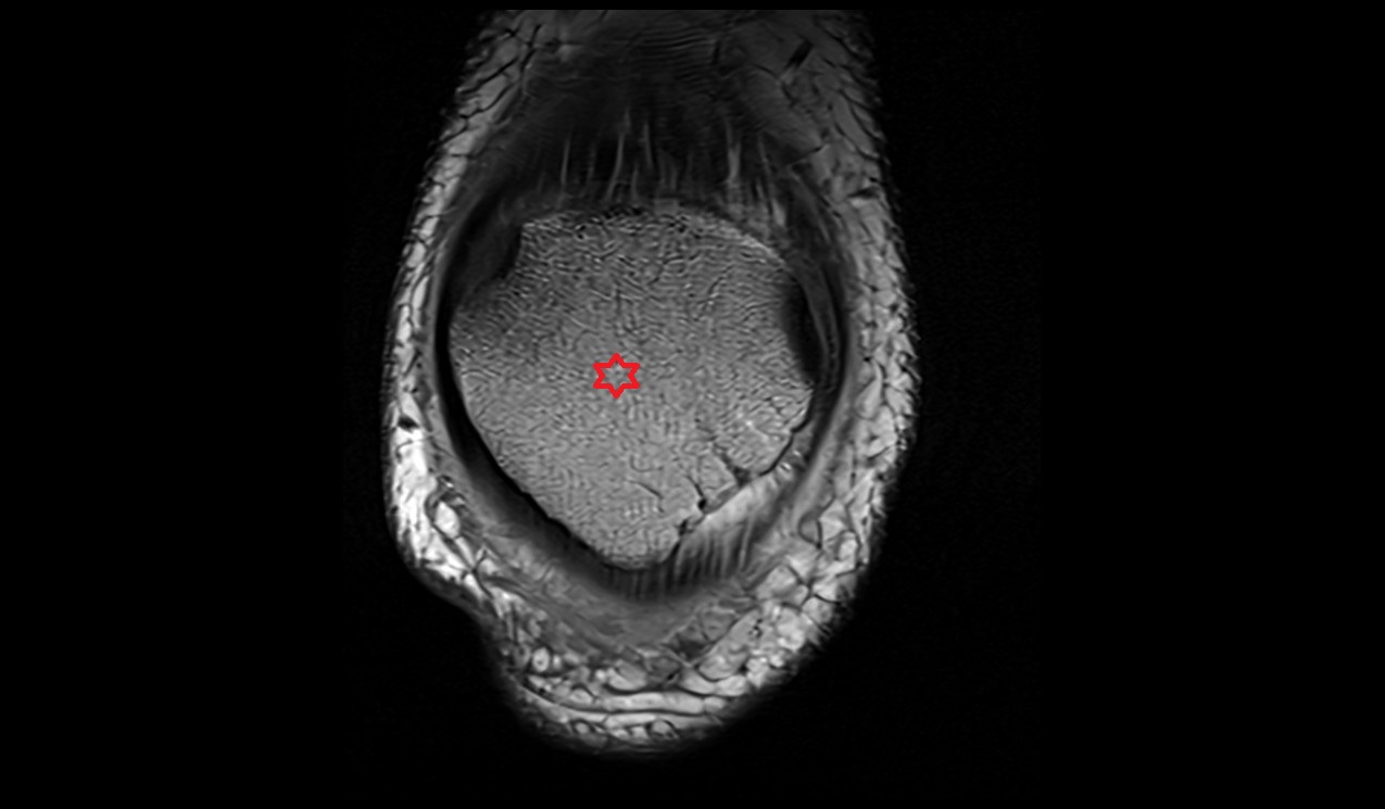 Patella bone anatomy image coronal 3t MRI