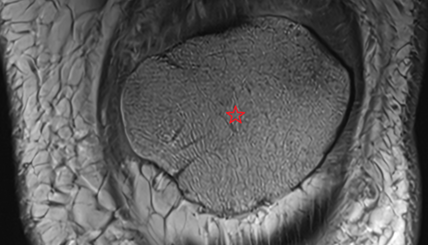 Patella coronal cross sectional anatomy 3T MRI AI enhanced  radiology  anatomy image-img-00000-00000