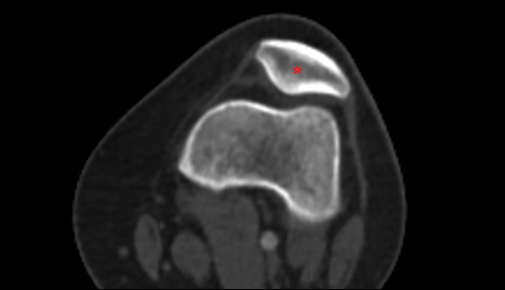 Patella ct axial