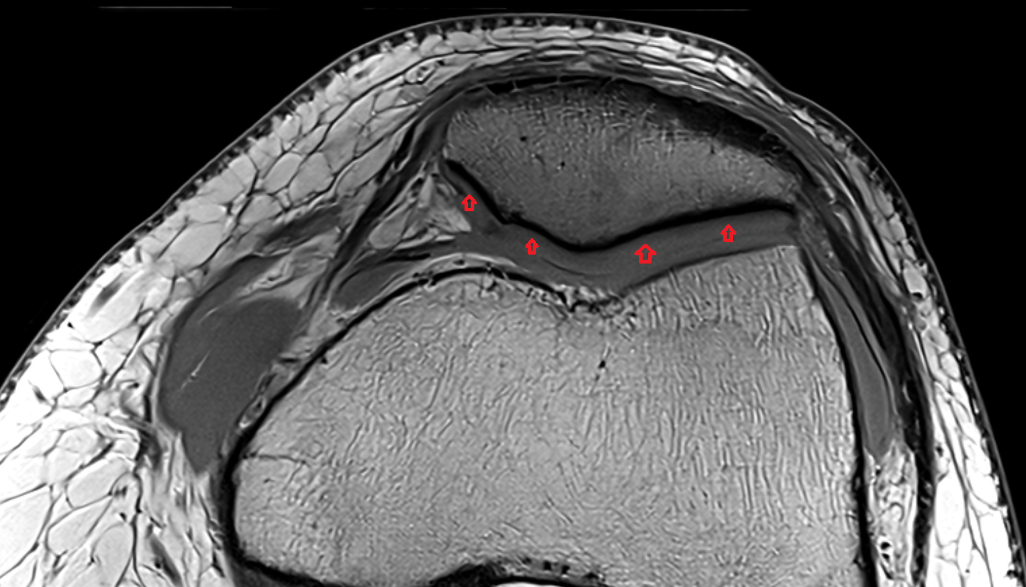 Patellar articular cartilage (chondral cartilage) axial cross sectional anatomy 3T MRI AI enhanced  radiology  anatomy image-img-00000-00000