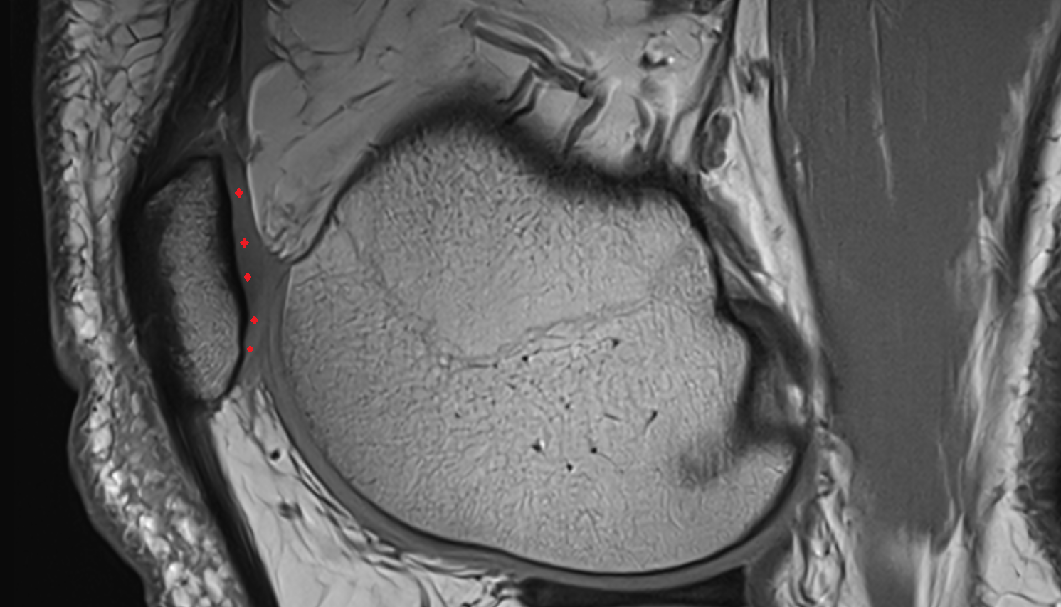 Patellar articular cartilage (chondral cartilage) sag cross sectional anatomy 3T MRI AI enhanced  radiology  anatomy image-img-00000-00000_00001
