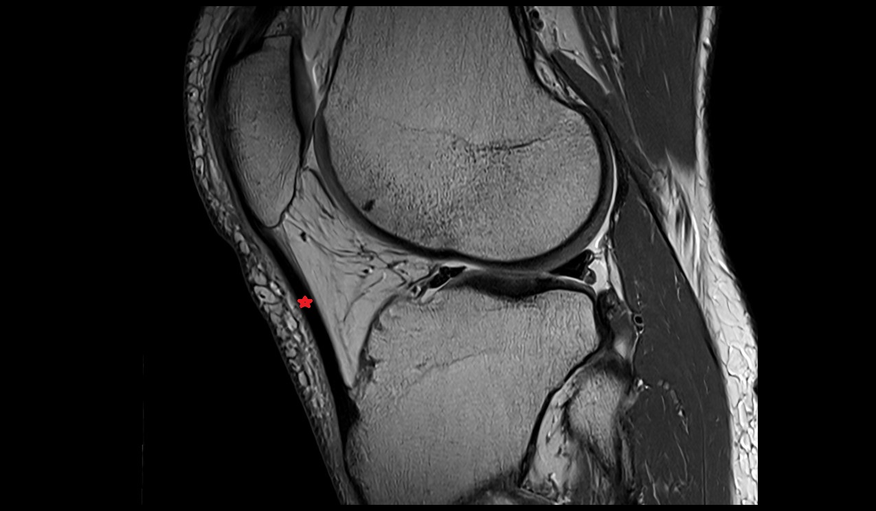 Patellar tendon or ligament anatomy image