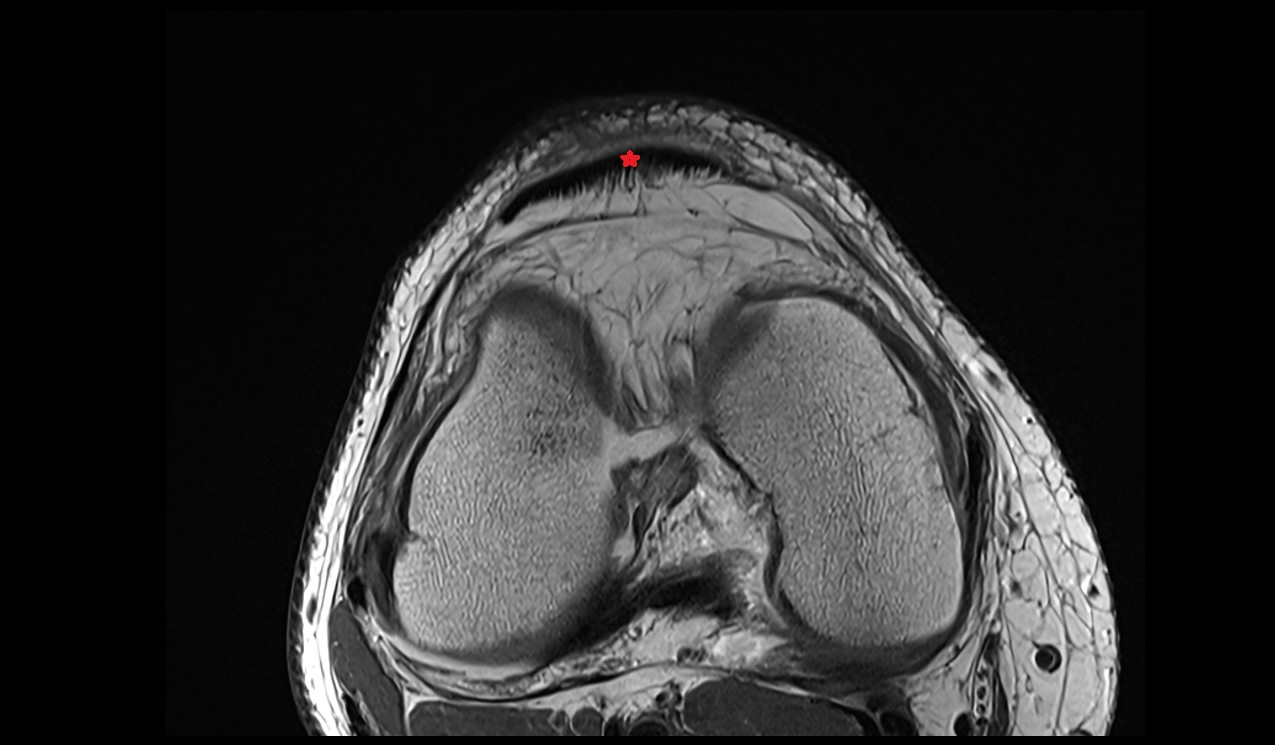 Patellar tendon or ligament radiology  anatomy image 3T MRI