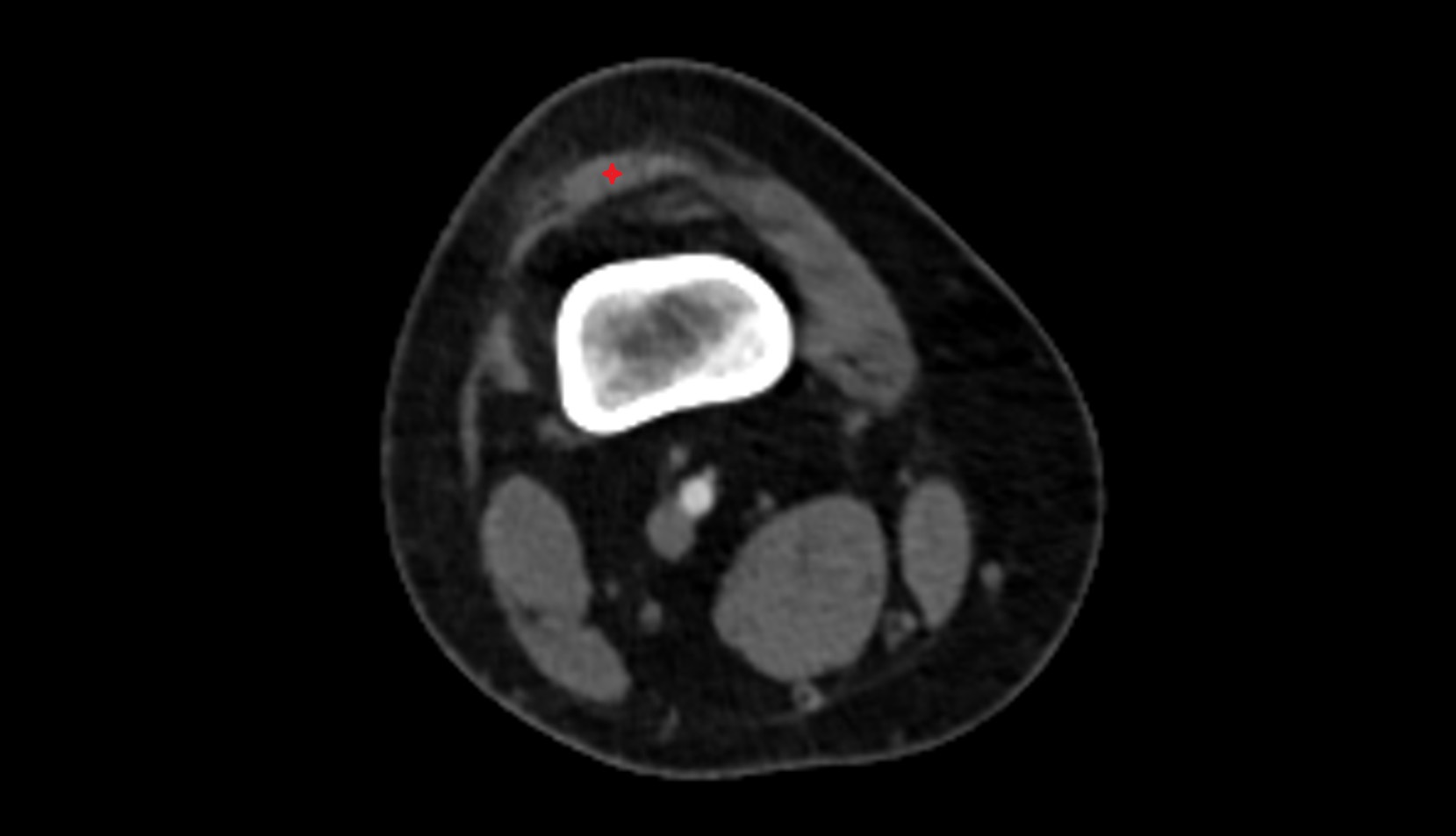 Patellar tendon (patellar ligament) CT axial image