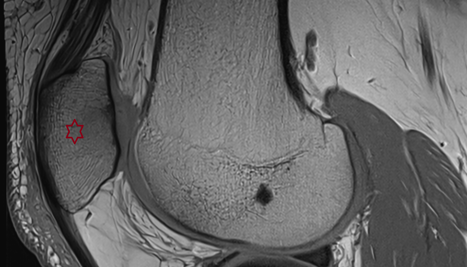 Patella sagittal cross sectional anatomy 3T MRI AI enhanced  radiology  anatomy image-img-00000-00000