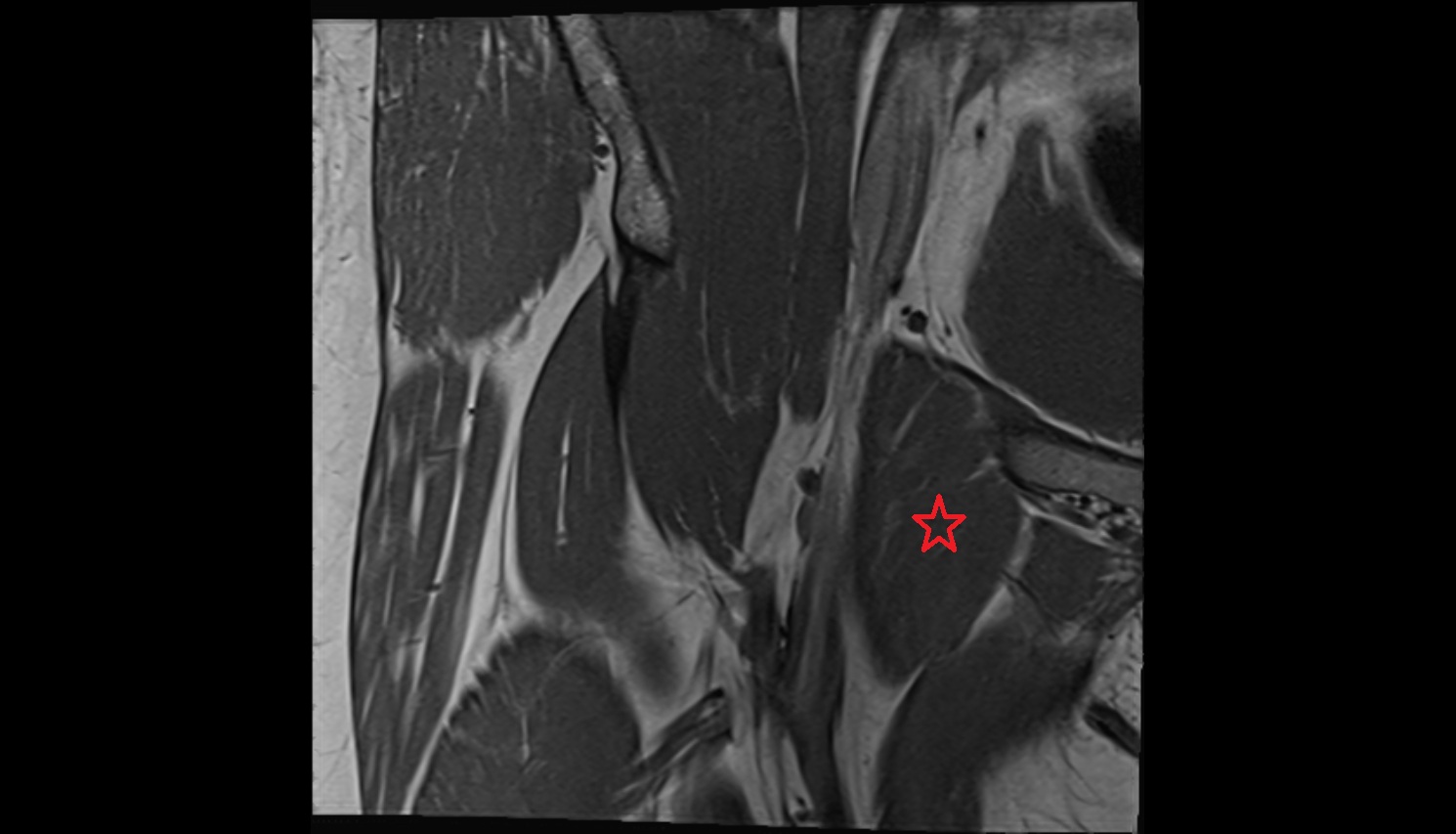 Pectineus muscle  MRI coronal anatomy image-img-00000-00000