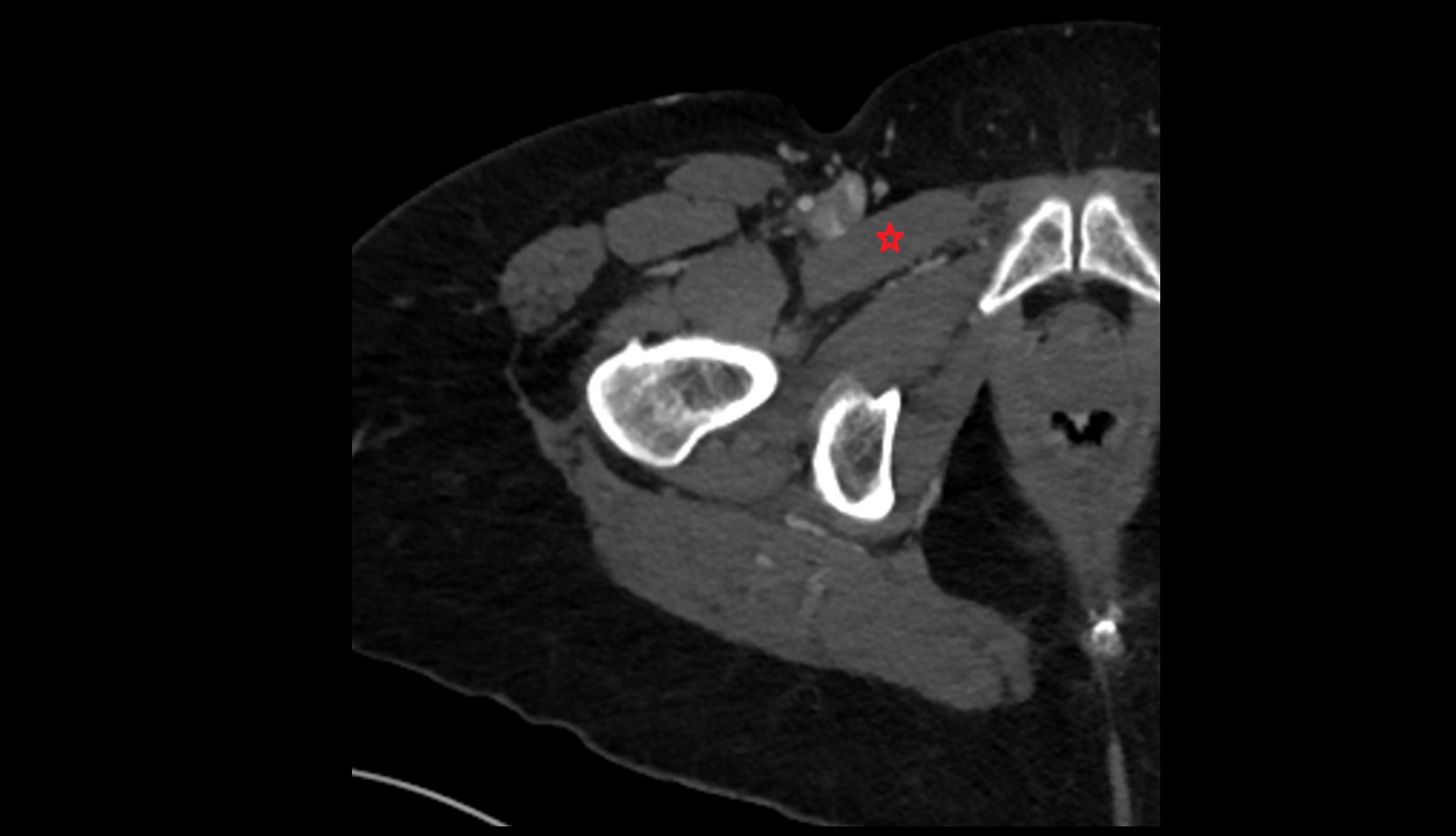 Pectineus muscle ct axial image