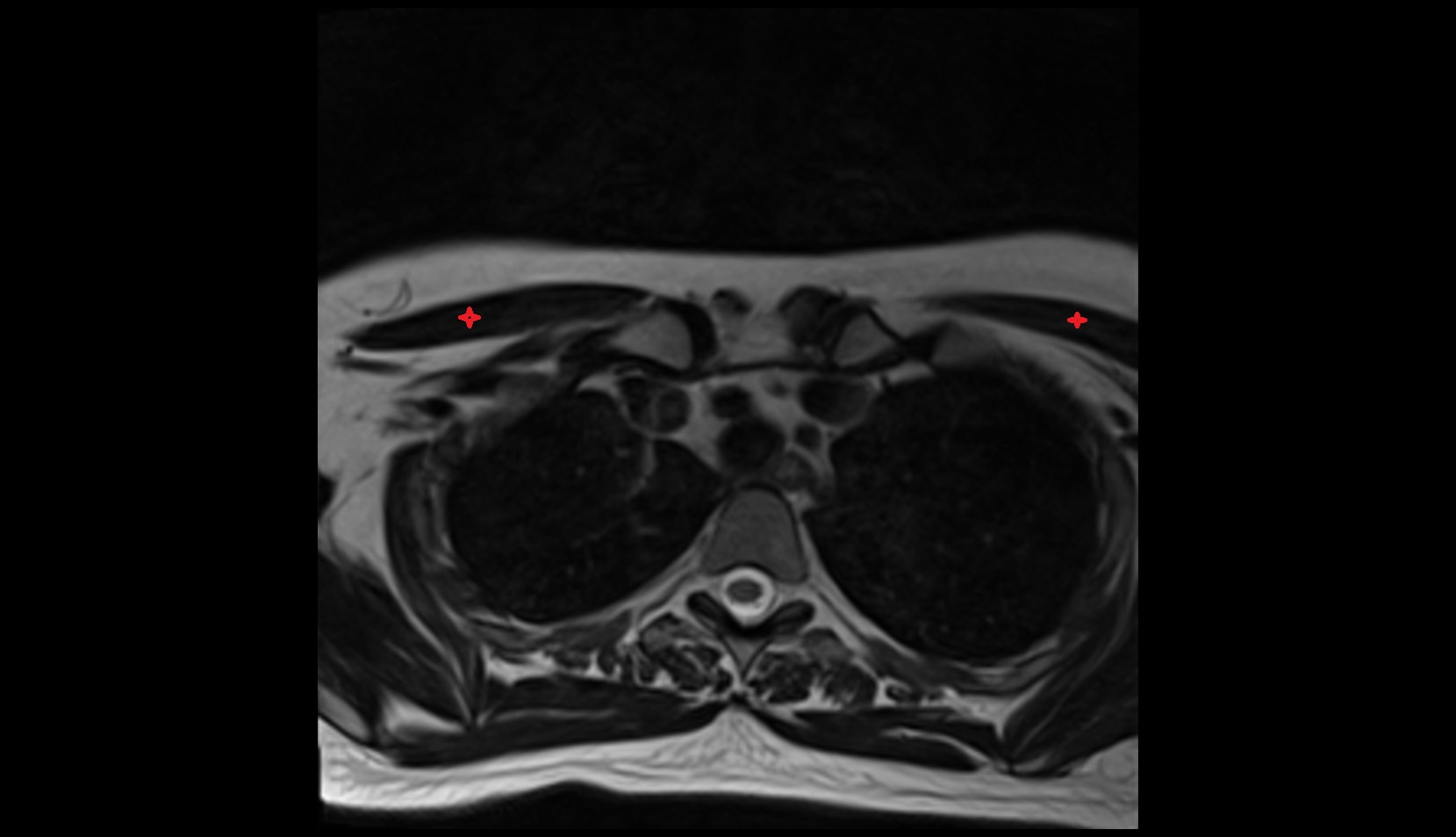 Pectoralis Major Muscle  Anatomy AXIAL MRI IMAGE