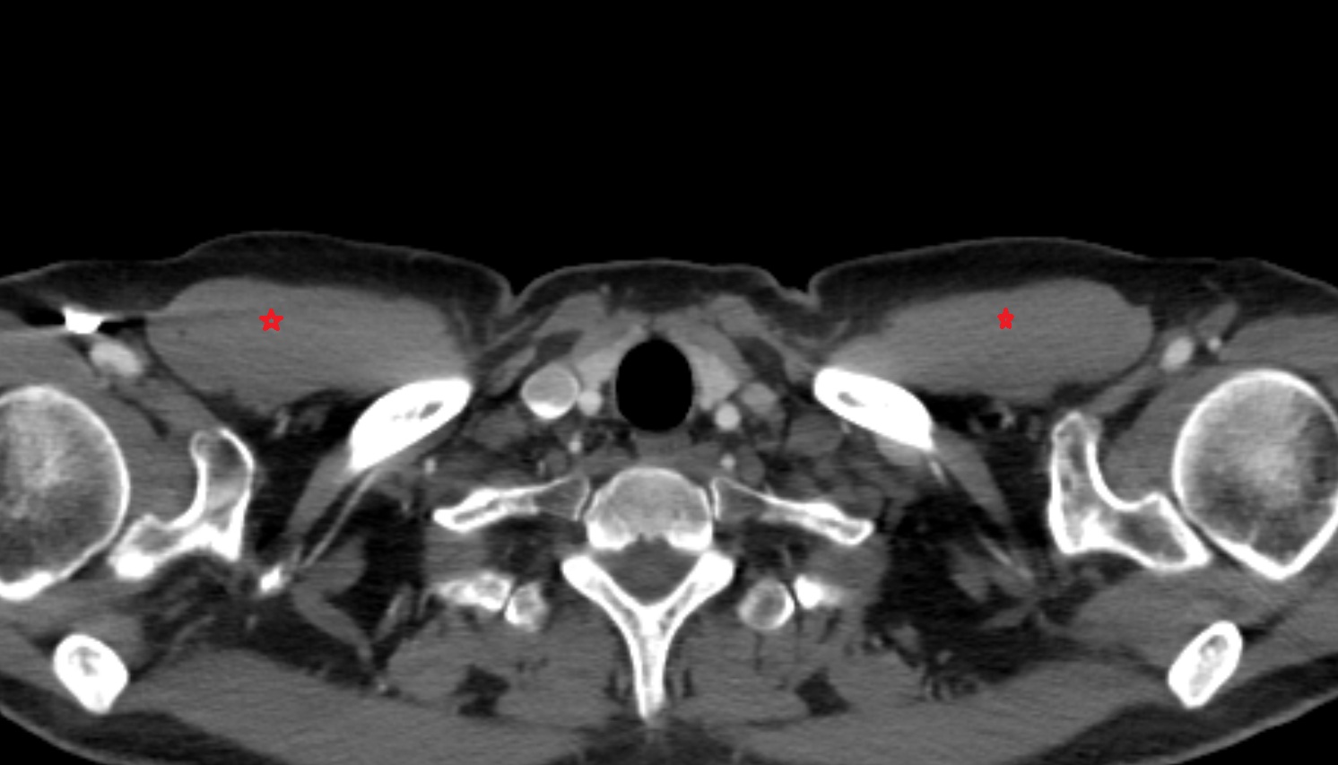 Pectoralis major muscle   anatomy CT axial  image -img-00000-00000_00001