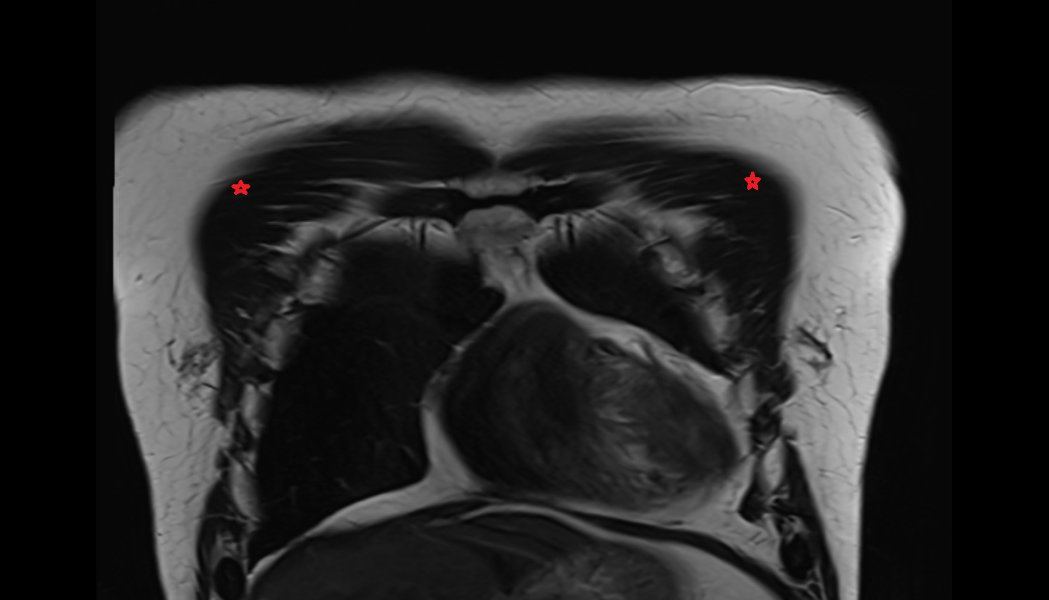 Pectoralis major muscle   anatomy MRI coronal  image -img-00000-00000