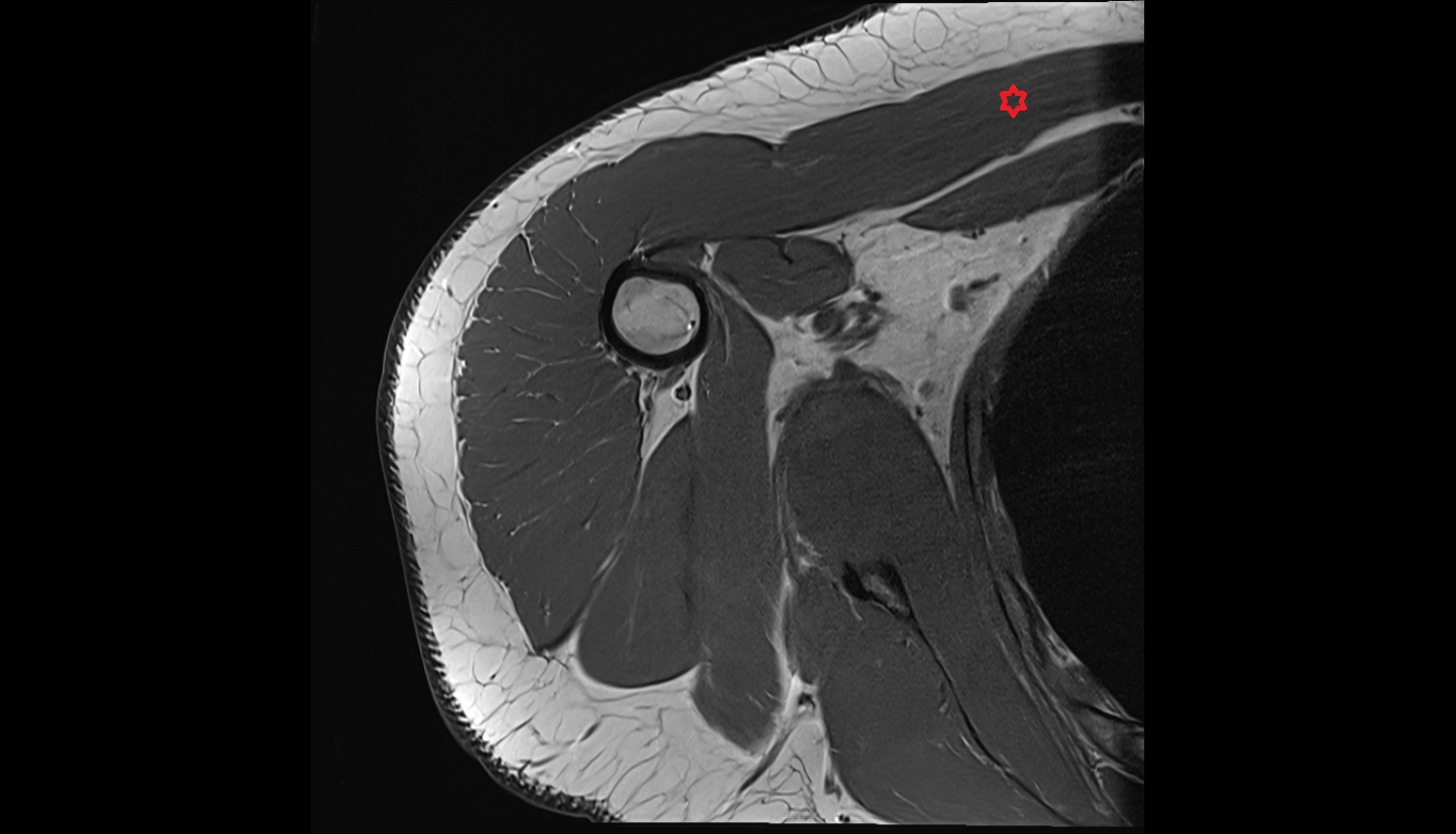 Pectoralis major muscle  axial cross sectional anatomy 3T MRI AI enhanced radiology image-img-00000-00000