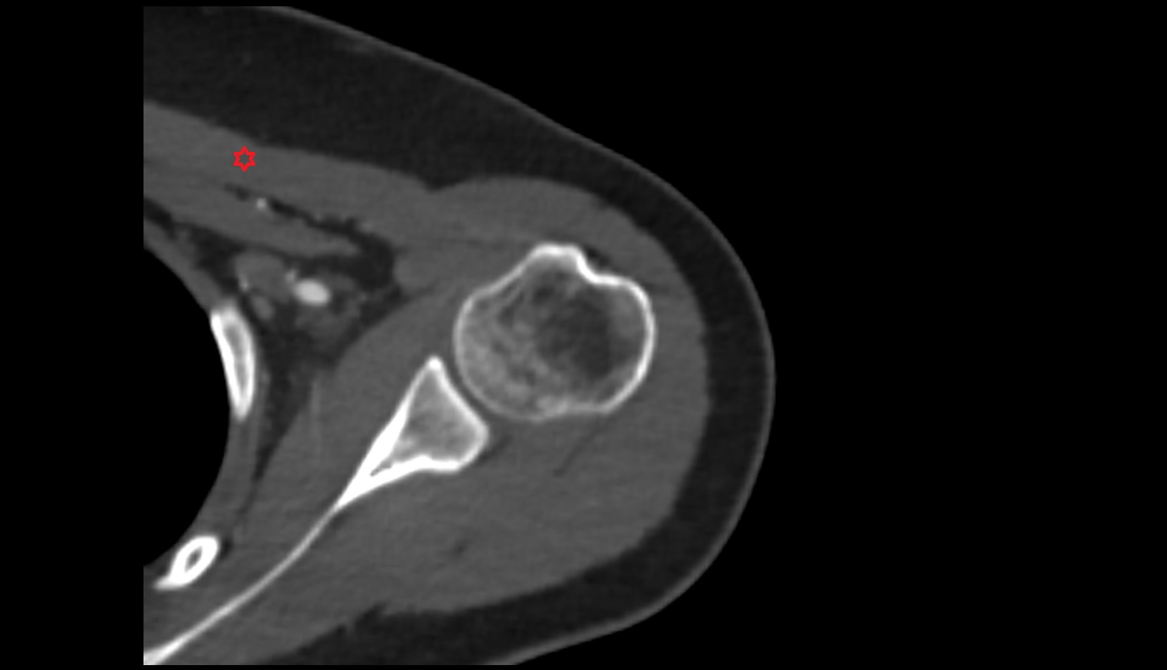 Pectoralis major  muscle axial shoulder ct