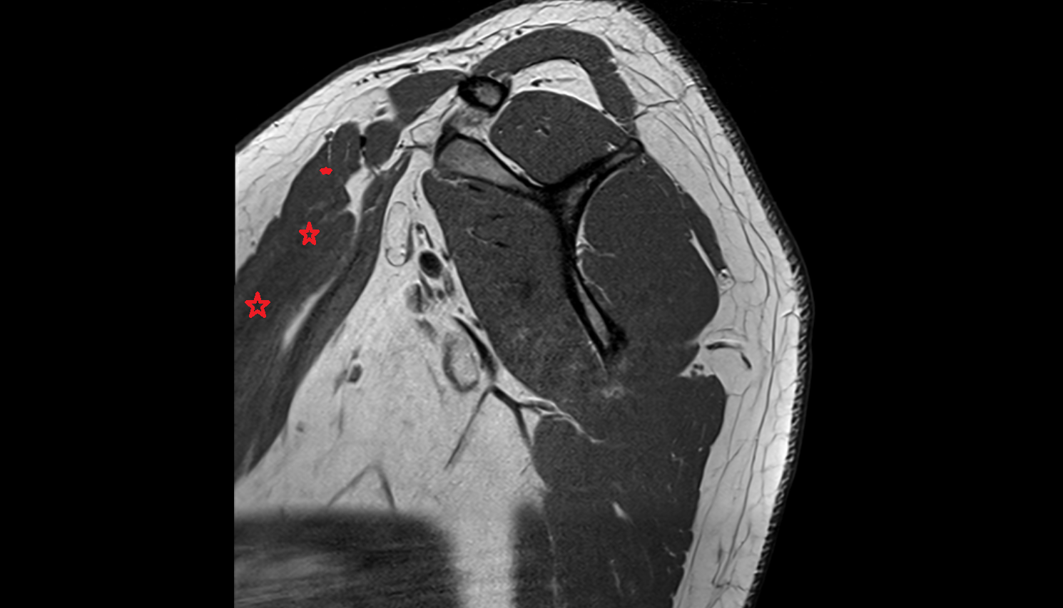 Pectoralis major muscle  sag  cross sectional anatomy 3T MRI AI enhanced radiology image-img-00000-00000