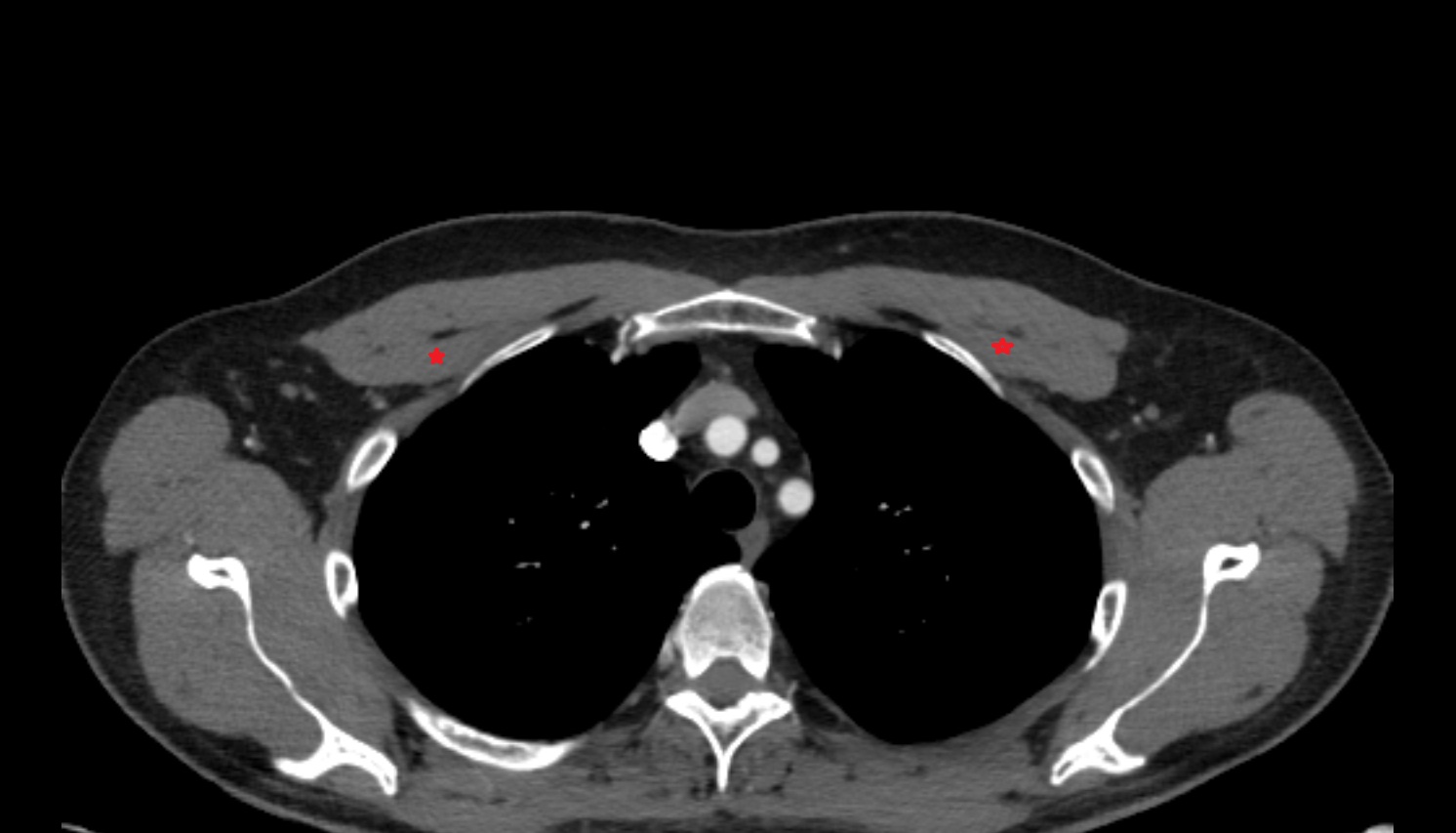 Pectoralis minor muscle  anatomy CT axial  image -img-00000-00000