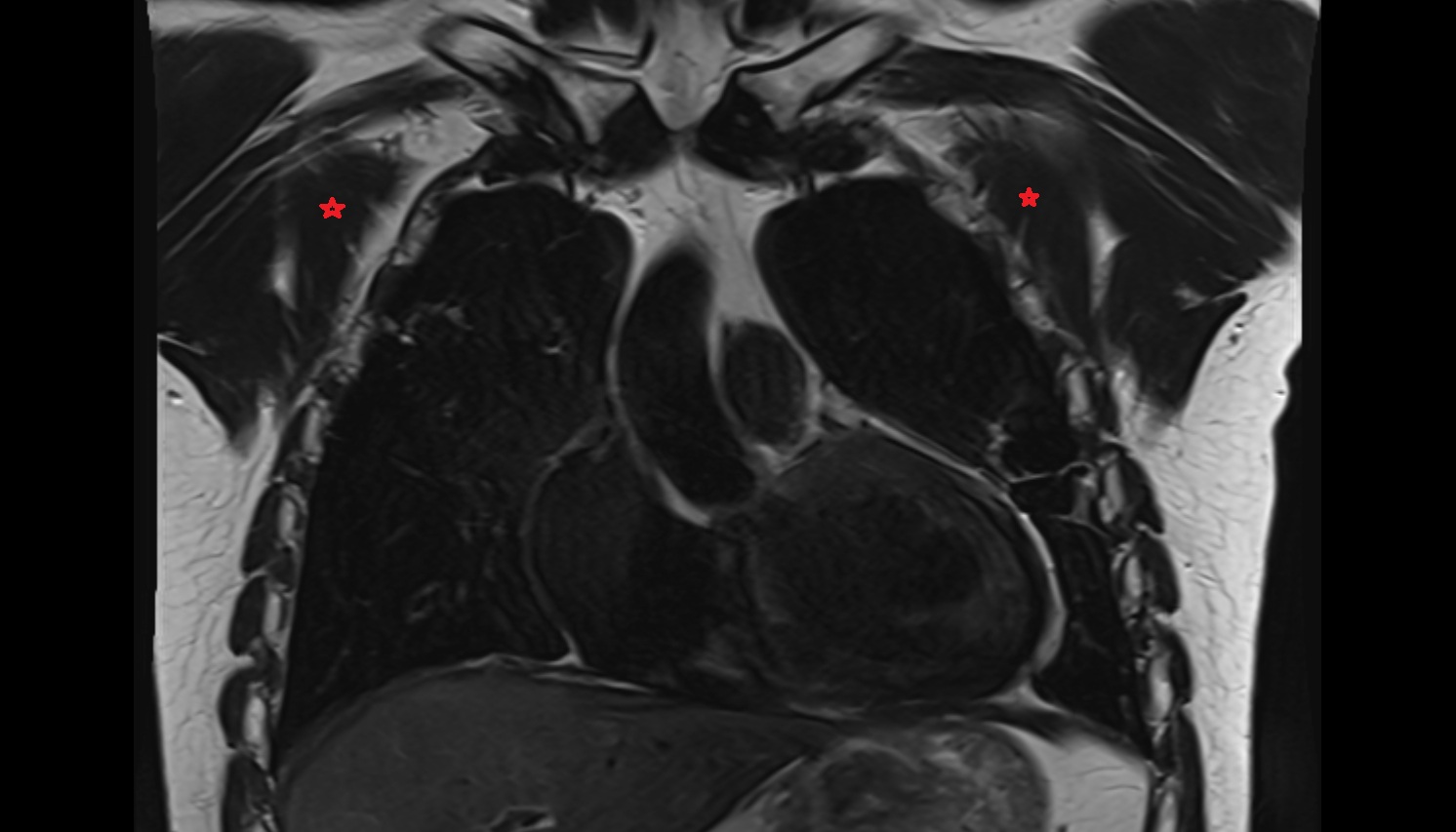 Pectoralis minor muscle   anatomy MRI coronal  image -img-00000-00000