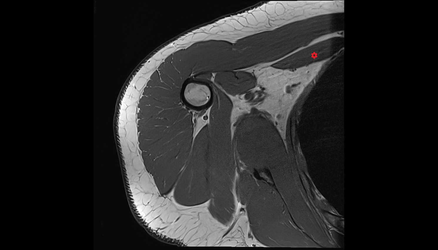 Pectoralis minor muscle  axial cross sectional anatomy 3T MRI AI enhanced radiology image-img-00000-00000