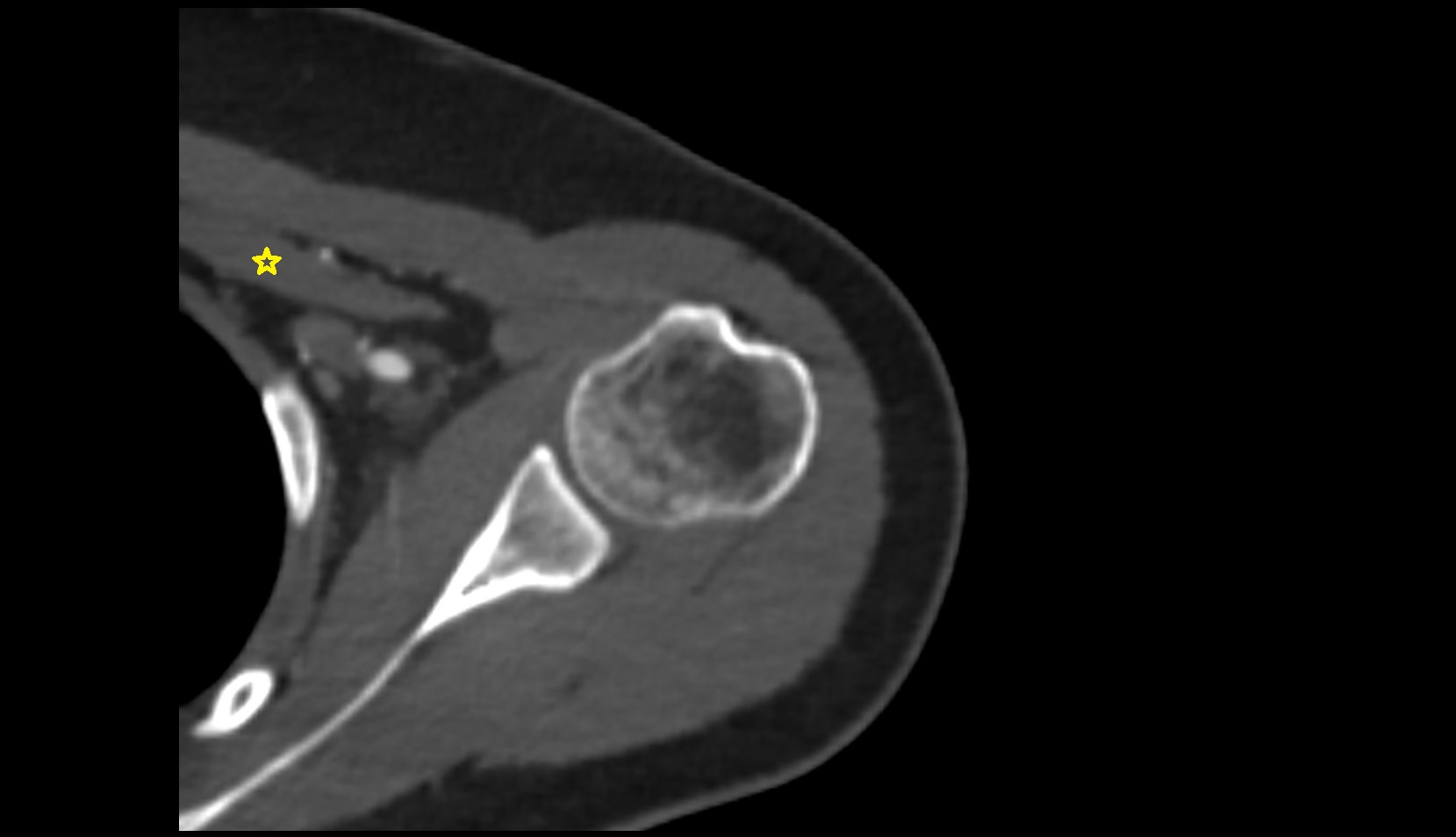Pectoralis minor muscle axial shoulder ct