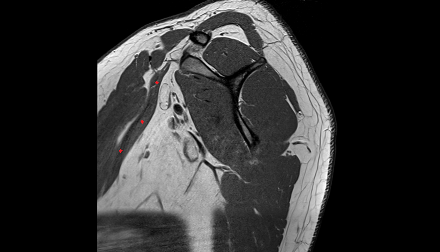 Pectoralis minor muscle  sag  cross sectional anatomy 3T MRI AI enhanced radiology image-img-00000-00000